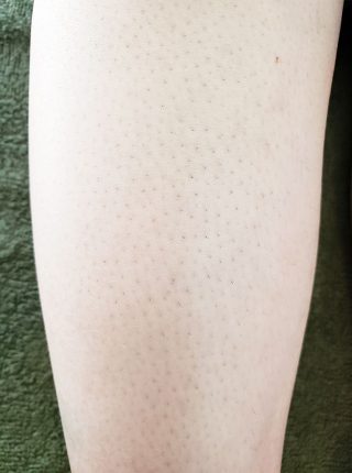 濃かった毛が薄くなっていくのを実感 La Foxy 大阪府 脱毛サロン 口コミ体験談