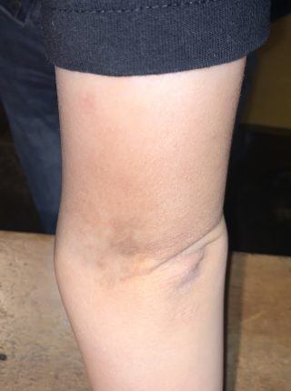 ラココを選んで良かったと心から思います ルミクス脱毛サロン ラココ札幌南店 北海道 ルミクス脱毛口コミ体験談